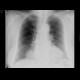 Mediastinal tumour, chest radiograph with expansion: X-ray - Plain radiograph