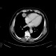 Mediastinal tumour: CT - Computed tomography