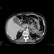 Adrenal tumour, extensive, embolotherapy: CT - Computed tomography