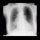 Lung tumour, adrenal metastasis, mediastinal lymphadenopathy: X-ray - Plain radiograph