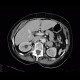 Lung tumour, adrenal metastasis, mediastinal lymphadenopathy: CT - Computed tomography