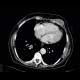 Lung tumour, adrenal metastasis, mediastinal lymphadenopathy: CT - Computed tomography