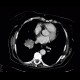 Lung tumour, adrenal metastasis, mediastinal lymphadenopathy: CT - Computed tomography