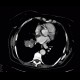 Lung tumour, adrenal metastasis, mediastinal lymphadenopathy: CT - Computed tomography