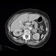 Lung tumour, adrenal metastasis, mediastinal lymphadenopathy: CT - Computed tomography