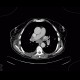 Lung carcinoma, carcinomatous lymphagiopathy: CT - Computed tomography