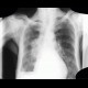 Lung tumour, pleural effusion, hydropneumothorax: X-ray - Plain radiograph
