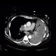 Lung tumour, tumorous infiltration of the lung wing: CT - Computed tomography