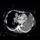 Lung tumour, tumorous infiltration of the lung wing: CT - Computed tomography