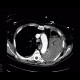 Lung tumour, tumorous infiltration of the lung wing: CT - Computed tomography