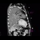 Lung tumour, tumorous infiltration of the lung wing: CT - Computed tomography