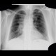 Lung tumour, postirradiation changes: X-ray - Plain radiograph