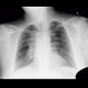 Lung tumour, postirradiation changes: X-ray - Plain radiograph