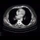 Lung tumour, postirradiation changes: CT - Computed tomography