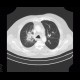 Lung tumour, postirradiation changes: CT - Computed tomography