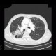 Bullous emphysema, lung tumour: CT - Computed tomography