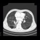 Bullous emphysema, lung tumour: CT - Computed tomography
