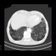 Bullous emphysema, lung tumour: CT - Computed tomography