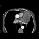 Lung tumour growing into the left atrium through a pulmonary vein: CT - Computed tomography