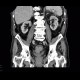 Colorectal cancer, carcinoma of rectum: CT - Computed tomography