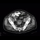 Colorectal cancer, carcinoma of rectum: CT - Computed tomography