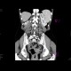 Tumour of rectum: CT - Computed tomography