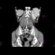 Tumour of rectum: CT - Computed tomography