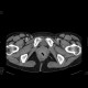 Tumour of rectum: CT - Computed tomography