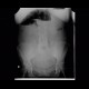 Carcinoma of sigmoid colon, large bowel obstruction, ileus: X-ray - Plain radiograph