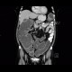 Carcinoma of sigmoid colon, large bowel obstruction, ileus: CT - Computed tomography