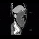 Carcinoma of sigmoid colon, large bowel obstruction, ileus: CT - Computed tomography