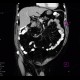 Tumour of jejunum: CT - Computed tomography