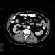 Tumour of jejunum: CT - Computed tomography