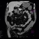 Tumour of jejunum: CT - Computed tomography