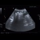 Tumour of large bowel on ultrasound: US - Ultrasound