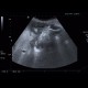 Tumour of large bowel on ultrasound: US - Ultrasound