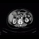 Carcinoma of gallbladder: CT - Computed tomography