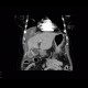 Carcinoma of gallbladder: CT - Computed tomography