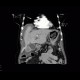 Carcinoma of gallbladder: CT - Computed tomography