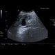 Carcinoma of gallbladder: US - Ultrasound