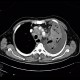 Lung cancer, infiltration of lung wing, metastasis in neuroforamina: CT - Computed tomography