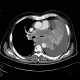 Lung cancer, infiltration of lung wing, metastasis in neuroforamina: CT - Computed tomography