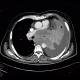 Lung cancer, infiltration of lung wing, metastasis in neuroforamina: CT - Computed tomography