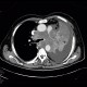 Lung cancer, infiltration of lung wing, metastasis in neuroforamina: CT - Computed tomography