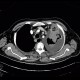 Lung cancer, infiltration of lung wing, metastasis in neuroforamina: CT - Computed tomography