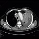 Lung cancer, infiltration of lung wing, metastasis in neuroforamina: CT - Computed tomography