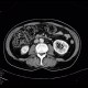 Lung cancer, infiltration of lung wing, metastasis in neuroforamina: CT - Computed tomography