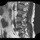 Lung cancer, infiltration of lung wing, metastasis in neuroforamina: MRI - Magnetic Resonance Imaging