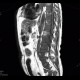 Lung cancer, infiltration of lung wing, metastasis in neuroforamina: MRI - Magnetic Resonance Imaging