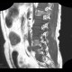 Lung cancer, infiltration of lung wing, metastasis in neuroforamina: MRI - Magnetic Resonance Imaging